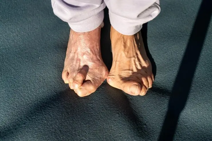 Bunion and foot alignment examination at Precision Podiatry clinic in Alma, MI
